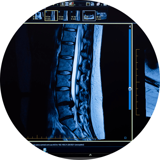 Lumbar spine L4/L5 disc prolapse ("slipped disc").